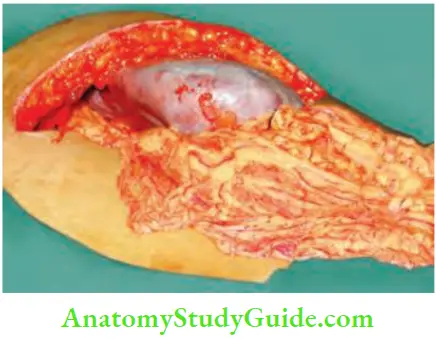 Spleen Splenectomy Done For Left Sided Portal Hypertension Due To Splenic Vein Thrombosis