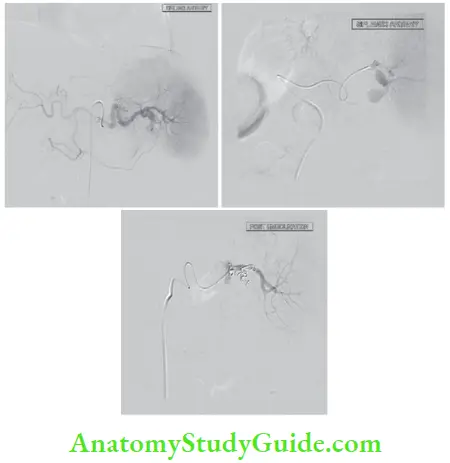 Spleen Splenic Artery Embolisation