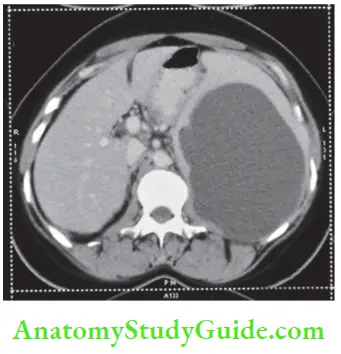 Spleen Splenic Cyst Coronal View
