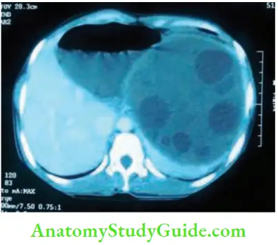 Spleen Splenic Hydatid Cyst