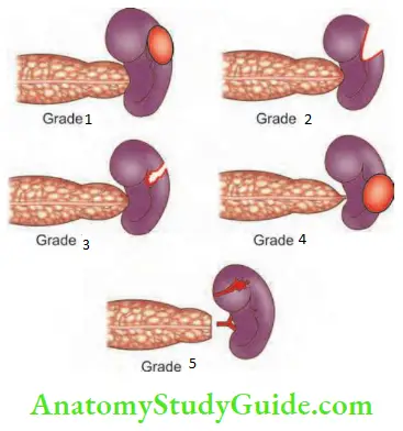 Spleen Various Grades Of Splenic Injury