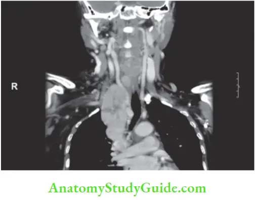 Thyroid Gland CT Neck And Chest Lymph Nodes Were Cleared After Sternotomy
