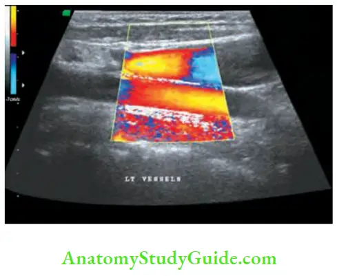 Thyroid Gland Colour Doppler Showing The Relationship Of The Gland To Major Vessels Of The Neck
