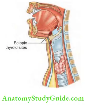 Thyroid Gland Ectopic Thyroid Sites