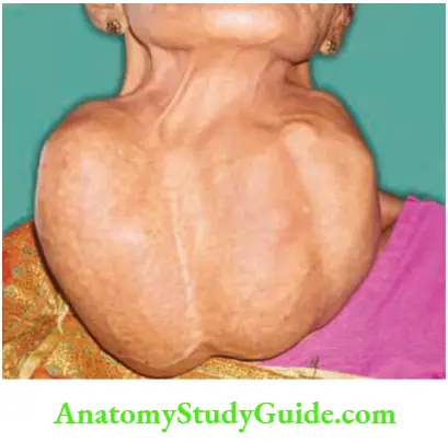Thyroid Gland Endemic Goitre Of 35 Years Duration Turned Into Multinodular Goitre