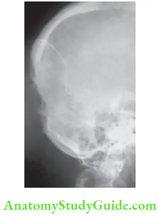 Thyroid Gland Erosion Of Skull Bone