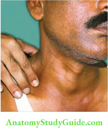 Thyroid Gland FNAC Anaplastic Carcinoma
