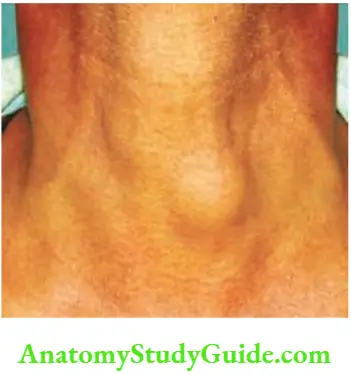 Thyroid Gland Hemithyroidec Tomy Solitary Toxic Nodule