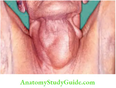 Thyroid Gland Observe The Engorged Veins Due To Retrosternal Goitre