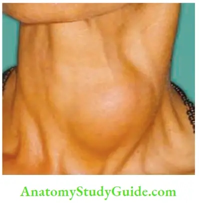 Thyroid Gland Papillary Carcinoma Thyroid Presenting As Solitary Nodule