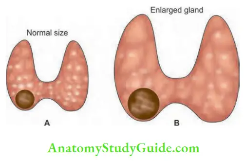 Thyroid Gland Solitary Nodule And Solitary Nodule