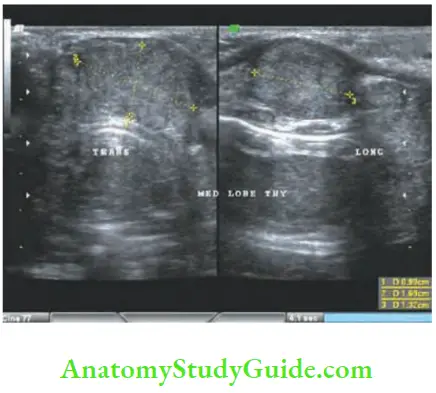 Thyroid Gland Ultrasound Revealing Recurrence