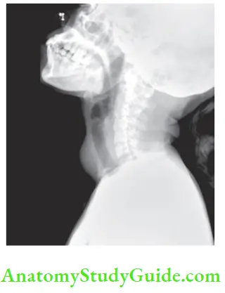 Thyroid Gland X Ray Of The Neck Lateral View