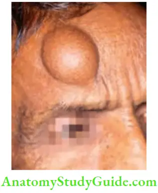 Tumours And Soft Tissue Sarcoma Lipoma Forehead