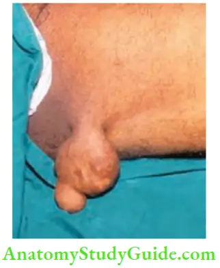 Tumours And Soft Tissue Sarcoma Pedunculated Papilloma Thigh Broad Base