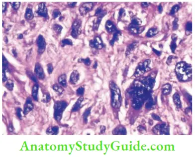 Tumours And Soft Tissue Sarcoma Spindle Cell Sarcoma