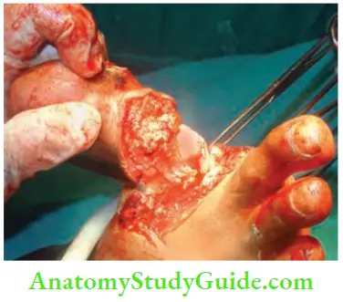 Tumours And Soft Tissue Sarcoma Synovial Sarcoma Of The Toe