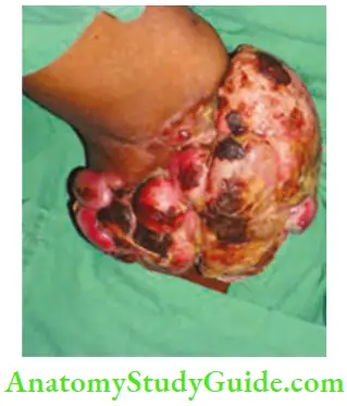Tumours And Soft Tissue Sarcoma Ulcerated Lesion In The Elbow Region Of Two Years Duration Presented To The Hospital With Bleeding