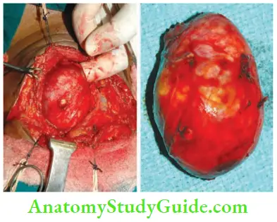 Tumours And Soft Tissue Sarcoma Vagal Schwannoma At Surgery