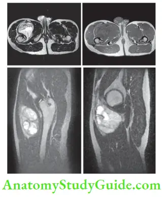 Tumours TumoT1 And T2 Weighted Axial MRI. Isointense To Hyperintense Mass Lesion Noted IN the Anterior Compartment Of Right Thigh. Sagittal T2 W MRI Shows Supero inferior Extent Of The Lesion