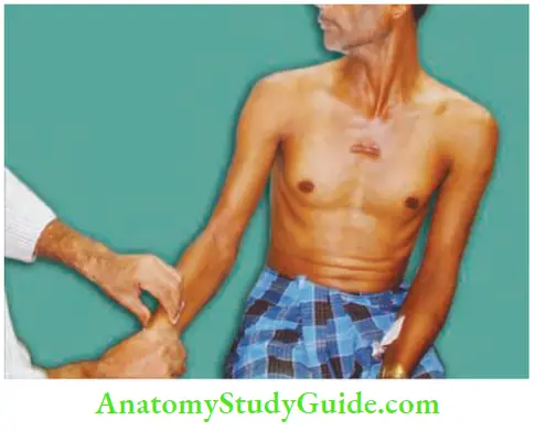 Upper Limb Ischaemia And Gangrene Adsons Test