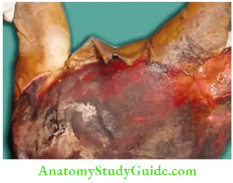 Upper Limb Ischaemia And Gangrene Emboli At The Branchial Artery Resulting In Massive Gangrene Of The Hand