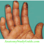 Upper Limb Ischaemia And Gangrene Gangrene Of The Tip Of Fingers Due To Cervical Rib