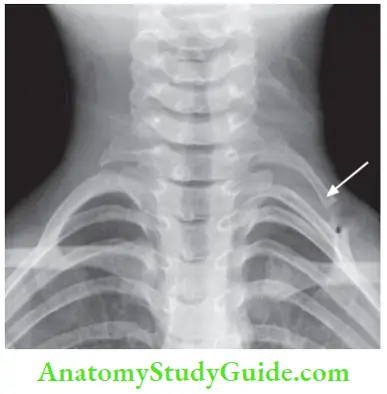 Upper Limb Ischaemia And Gangrene X Ray Of The Neck Showing Cervical Rib