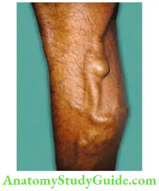 Varicose Veins And Deep Vein Thrombosis Classical Blow Out
