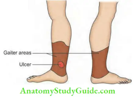 Varicose Veins And Deep Vein Thrombosis Gaiter Areas Are Those Areas Where Skin Changes And Venous Stasis Ulcer Occurs Due To Ambulatory Venous Hypertension