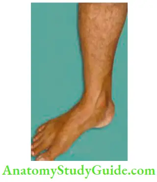 Varicose Veins And Deep Vein Thrombosis Grade 0