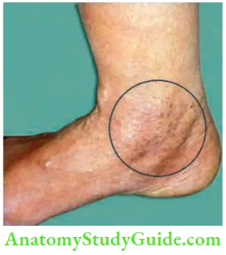 Varicose Veins And Deep Vein Thrombosis Grade 1