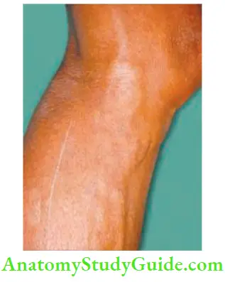 Varicose Veins And Deep Vein Thrombosis Grade 2