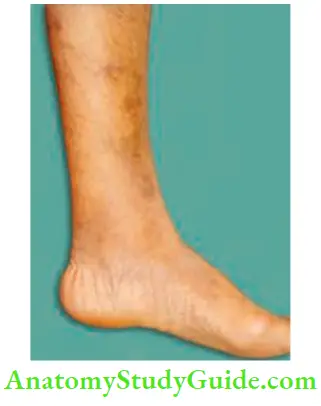 Varicose Veins And Deep Vein Thrombosis Grade 3