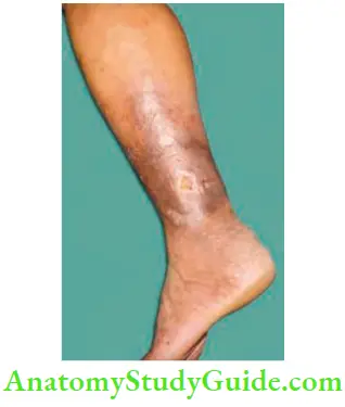 Varicose Veins And Deep Vein Thrombosis Grade 4