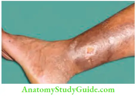 Varicose Veins And Deep Vein Thrombosis Observe Pigmentation, Lipodermatosclerosis And Ulcer Formation