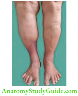 Varicose Veins And Deep Vein Thrombosis Patient With DVT