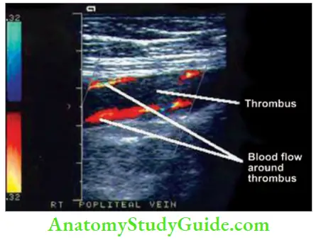 Varicose Veins And Deep Vein Thrombosis Popliteal Vein Thrombosis