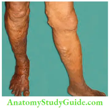 Varicose Veins And Deep Vein Thrombosis Rapid Filling On Releasing Pressure