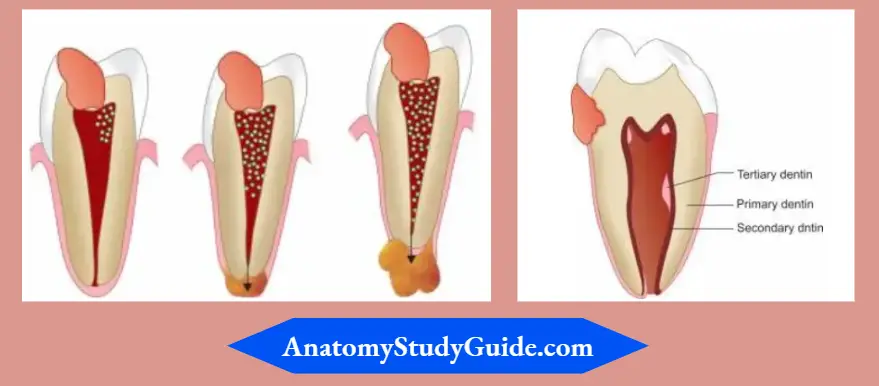 Pulpal-Response-To-Caries-And-Dental-Procedure-Sequelae-of-caries