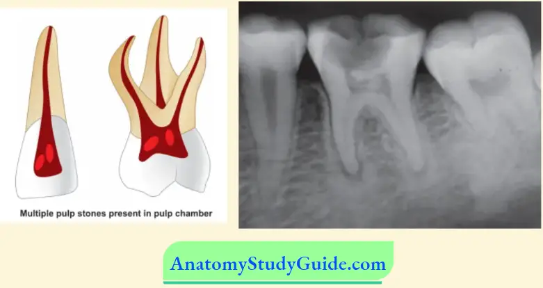 Internal Resorption Or Pink Tooth of Mummery Pulp Degeneration
